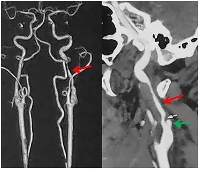 Stent-Assisted Angioplasty in Spontaneous Bilateral Extracranial Internal Carotid Artery Dissection